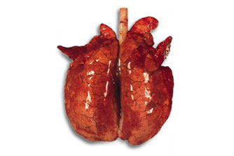 간질성 폐렴